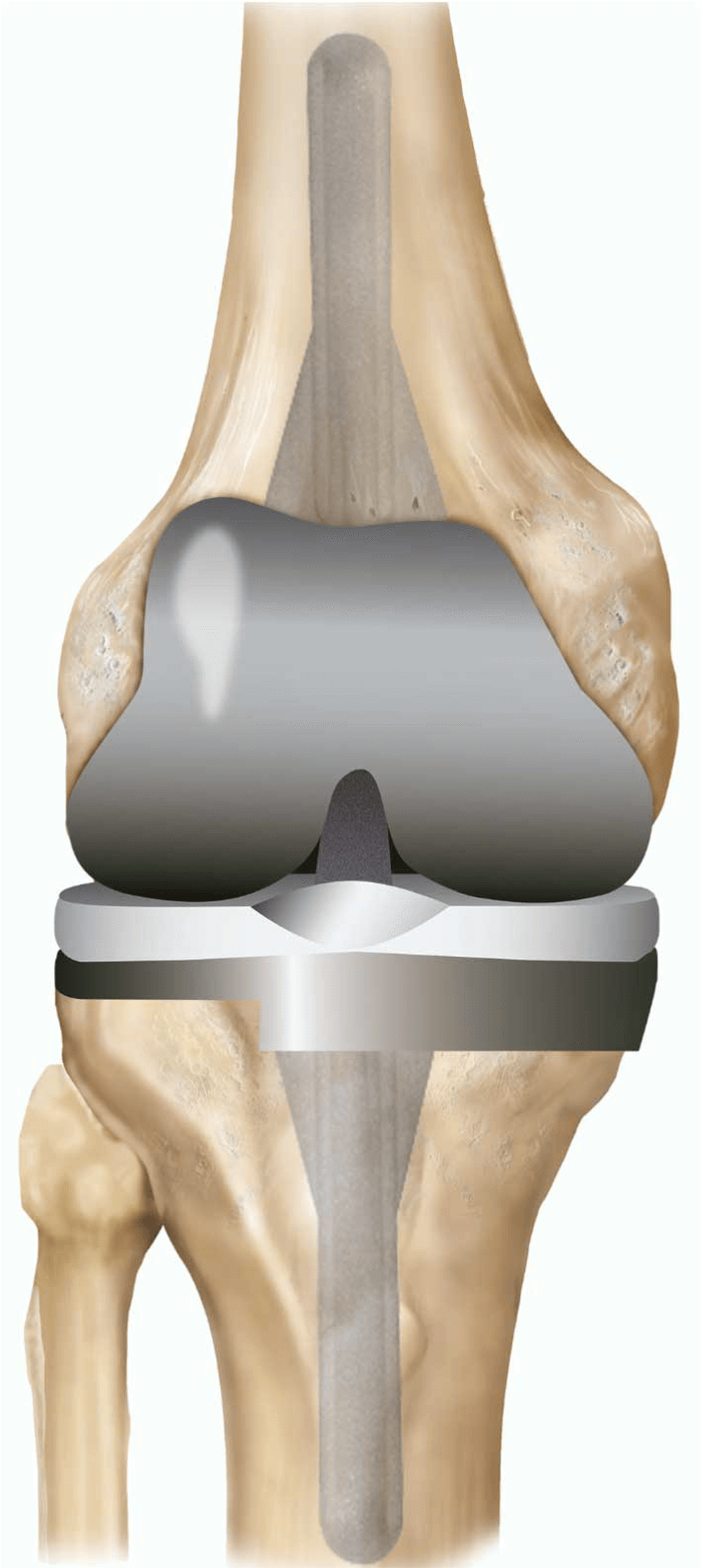 best revision total knee replacement surgeon